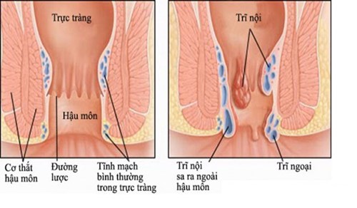 Dấu hiệu của bệnh là sự xuất hiện của búi trĩ ở hậu môn