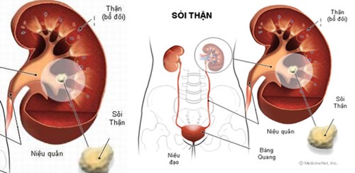 Phì đại tuyến tiền liệt gây ra các bệnh lý ở thận