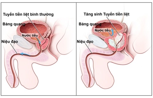 Tăng sinh phù nề tuyến tiền liệt là nguyên nhân gây viêm nhiễm