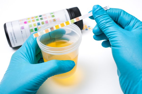 Xét nghiệm nước tiểu là cách để xác định viêm bàng quang chính xác nhất