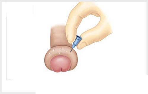 Bao quy đầu bị phồng do bộ phận sinh dục bị vi khuẩn hoặc tổn thương