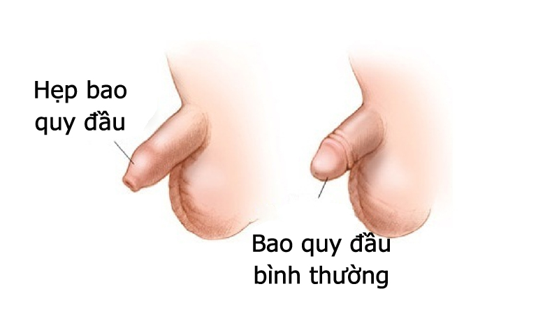 Bao quy đầu có nhiều bựa trắng thường do vấn đề hẹp bao quy đầu