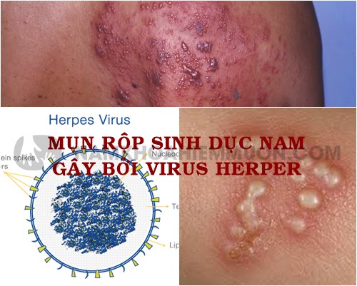 Mụn rộp sinh dục là bệnh gây bởi virus Herpes Simplex