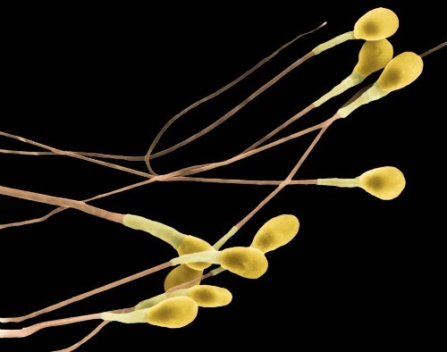 Tinh trùng màu vàng chứng tỏ điều bất thường của cơ thể nam giới