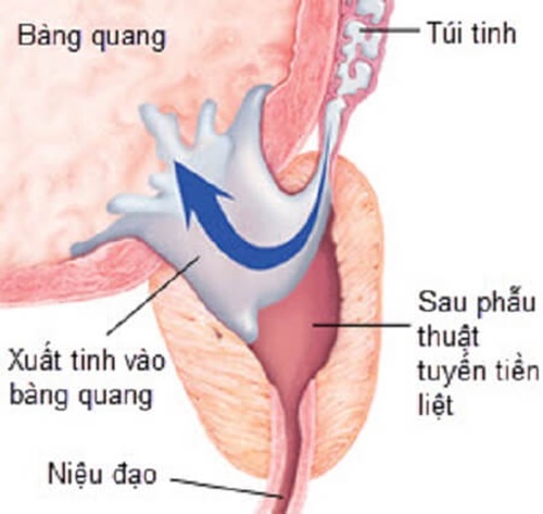 Nguyên nhân gây bệnh là do đã từng tiến hành phẫu thuật ở cơ quan sinh dục